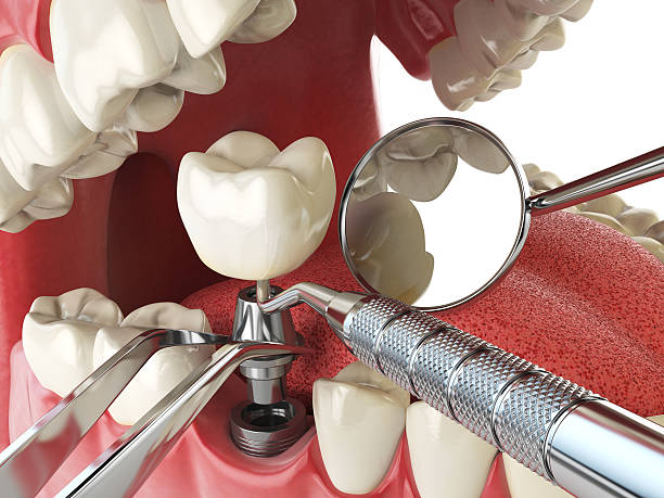 Best Emergency Treatment for Toothache in Syracuse, IN